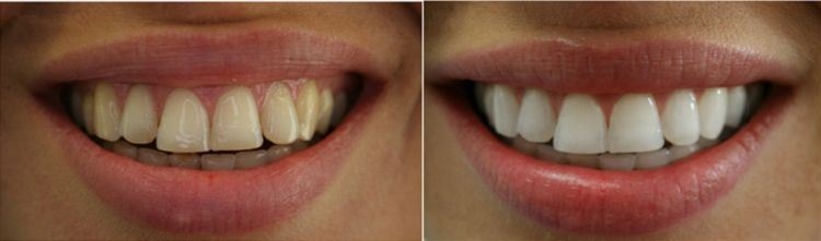 Teeth Whitening Kit for Strips