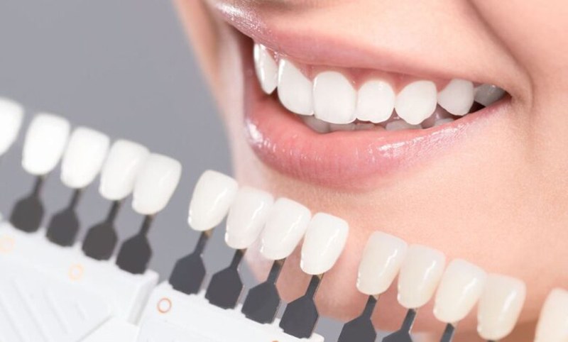 How many Shades Can Teeth Whitening Generally Improve?cid=13